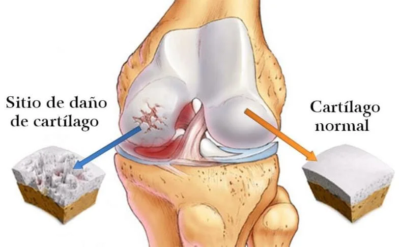 Sitio de daño de cartílago vs. cartílago normal — Hondrexil regenera la matriz articular