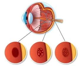 Anatomía del ojo y estadios de salud retiniana — Oculax protege la mácula